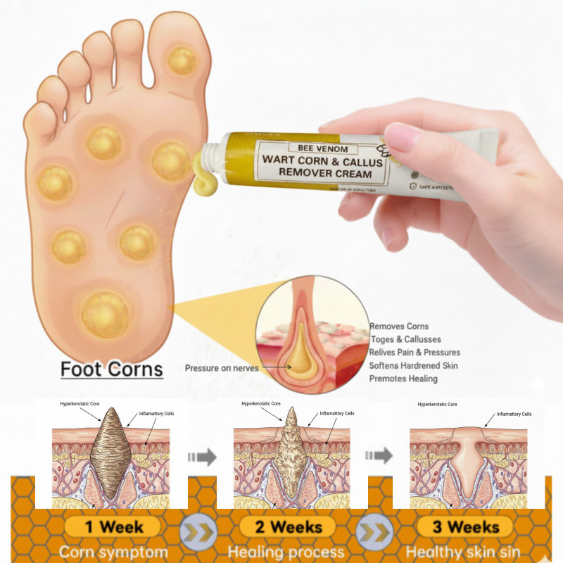 Bee Venom Corn and Callus Removal Cream | Soft Heels for Sandals