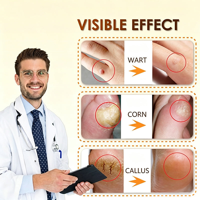 Bee Venom Corn and Callus Removal Cream | Soft Heels for Sandals